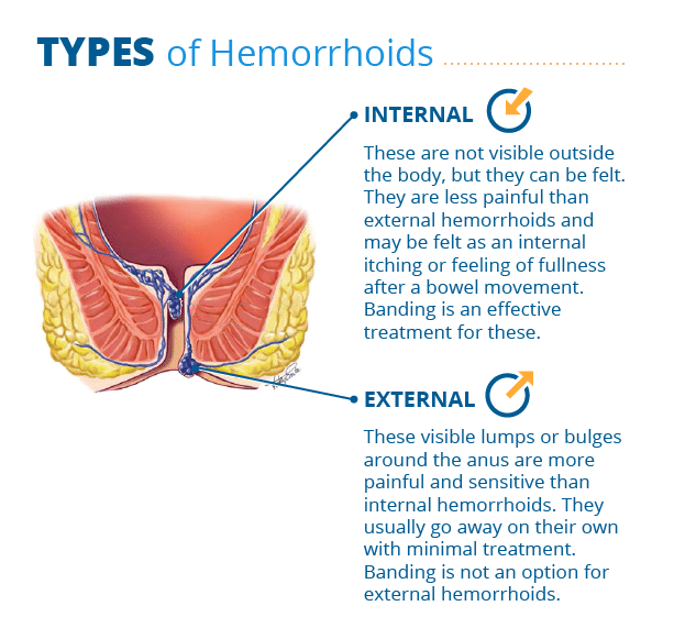 types of hemorrhoids