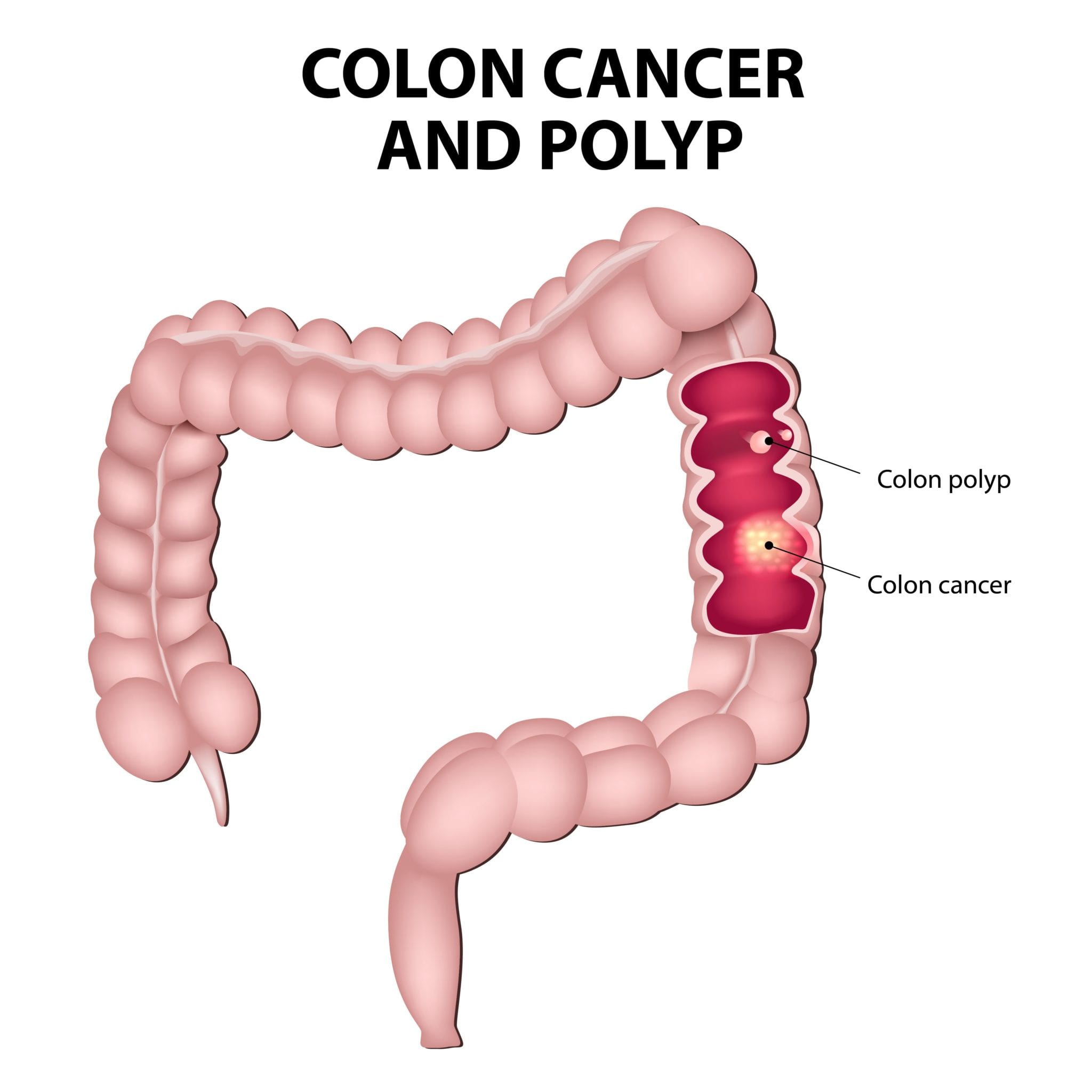 Hyperplastic Bowel Polyp Hyperplastic Bowel Polyp